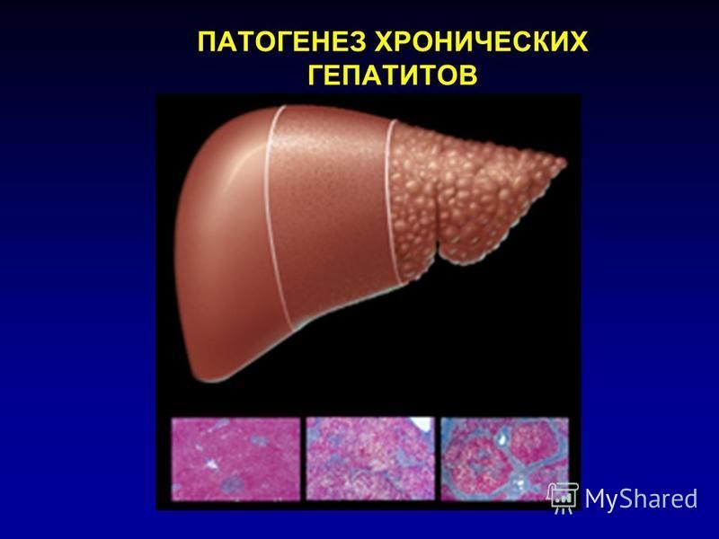 Презентация на тему хронический гепатит