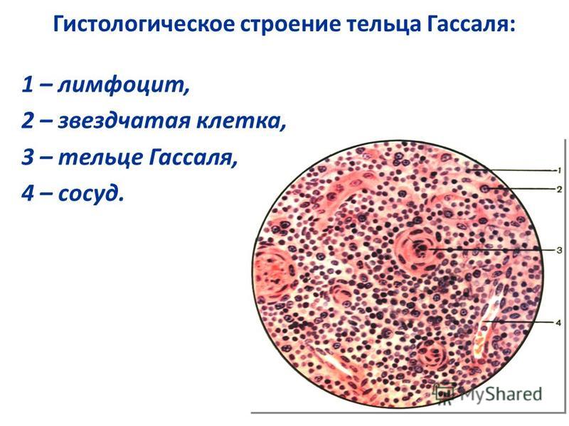 Гистологическое строение тельца Гассаля: 1 – лимфоцит, 2 – звездчатая клетка, 3 – тельце Гассаля, 4 – сосуд.