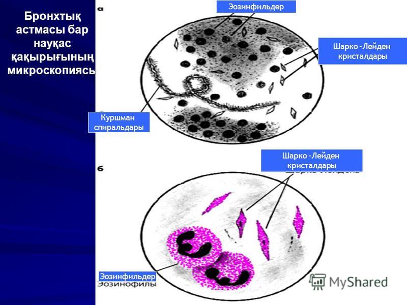 Эозинфильдер Шарко –Лейден кристалдары Куршман спиральдары Шарко –Лейден кристалдары Эозинфильдер Бронхтық астмасы бар науқас қақырығының микроскопиясы