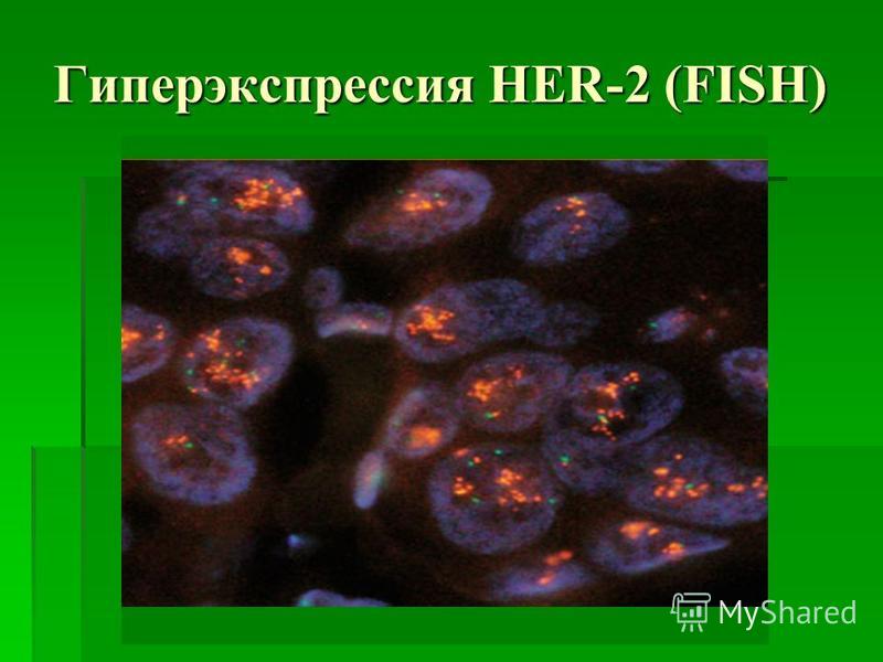 Гиперэкспрессия HER-2 (FISH)