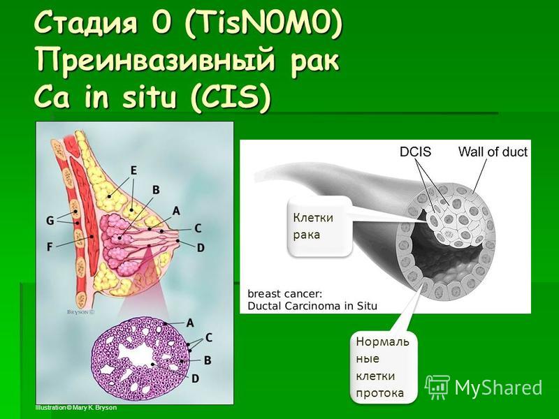 Стадия 0 (TisN0M0) Преинвазивный рак Ca in situ (CIS) 36 Illustration © Mary K. Bryson Клетки рака Нормаль ные клетки протока