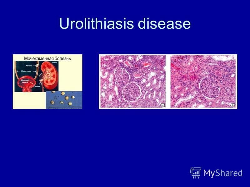 Urolithiasis disease