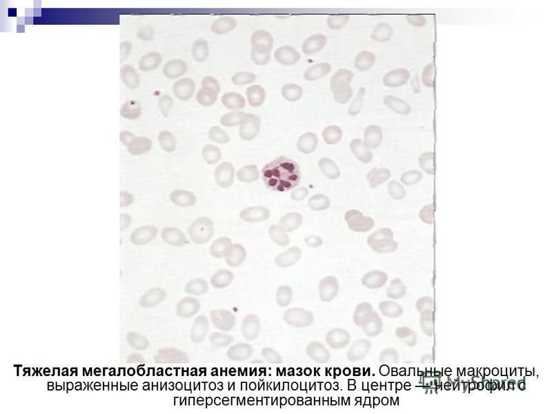 Тяжелая мегалобластная анемия: мазок крови. Овальные макроциты, выраженные анизоцитоз и пойкилоцитоз. В центре нейтрофил с гиперсегментированным ядром