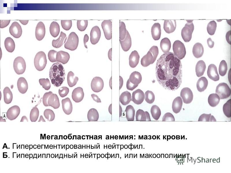 Мегалобластная анемия: мазок крови. А. Гиперсегментированный нейтрофил. Б. Гипердиплоидный нейтрофил, или макоополииит.