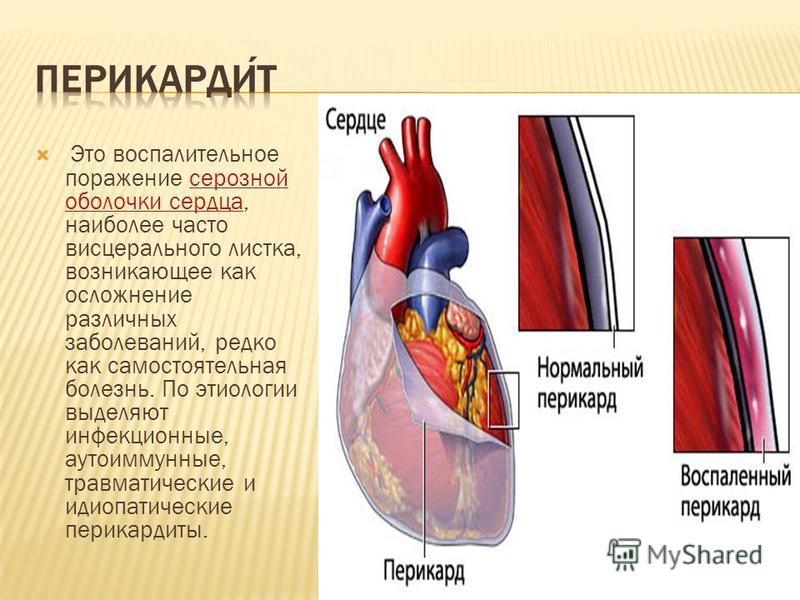 Это воспалительное поражение серозной оболочки сердца, наиболее часто висцерального листка, возникающее как осложнение различных заболеваний, редко как самостоятельная болезнь. По этиологии выделяют инфекционные, аутоиммунные, травматические и идиопа
