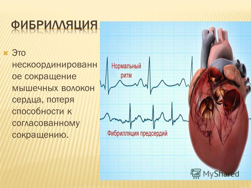 Это не с координированное сокращение мышечных волокон сердца, потеря способности к согласованному сокращению.