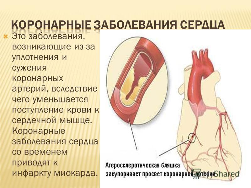 Это заболевания, возникающие из-за уплотнения и сужения коронарных артерий, вследствие чего уменьшается поступление крови к сердечной мышце. Коронарные заболевания сердца со временем приводят к инфаркту миокарда.