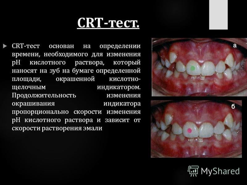 CRT-тест. CRT-тест основан на определении времени, необходимого для изменения рН кислотного раствора, который наносят на зуб на бумаге определенной площади, окрашенной кислотно- щелочным индикатором. Продолжительность изменения окрашивания индикатора