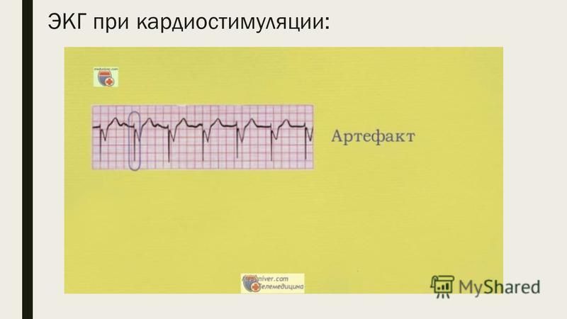 ЭКГ при кардиостимуляции: