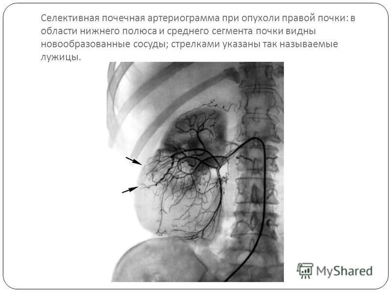 Селективная почечная артериограмма при опухоли правой почки : в области нижнего полюса и среднего сегмента почки видны новообразованные сосуды ; стрелками указаны так называемые лужицы.