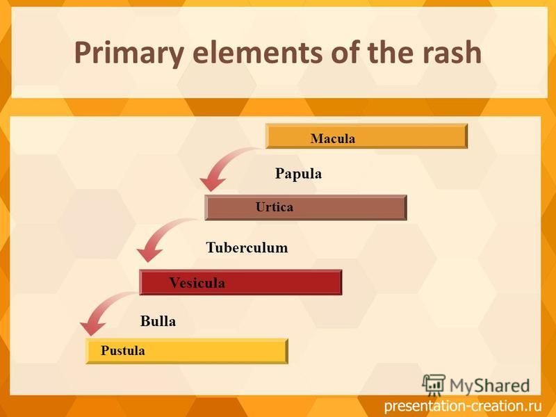 Primary elements of the rash Vesicula Urtica Macula Pustula Papula Tuberculum Bulla