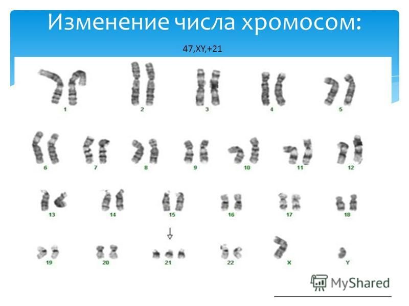 Изменение числа хромосом: 47,XY,+21