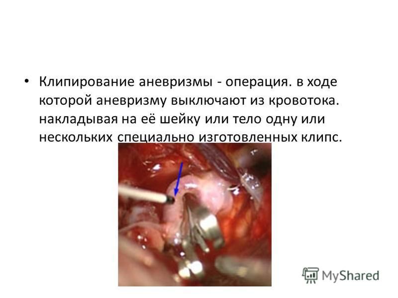 Клипирование аневризмымы - операция. в ходе которой аневризмыму выключают из кровотока. накладывая на её шейку или тело одну или нескольких специально изготовленных клипс.