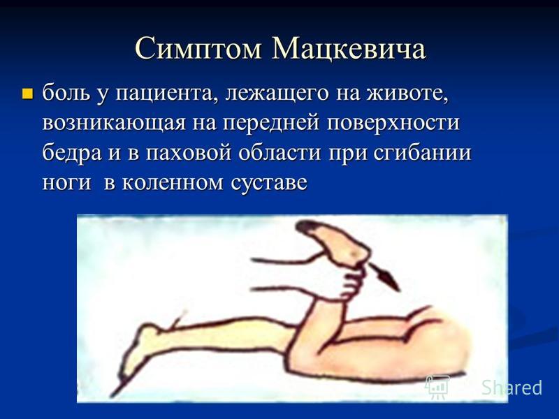 Симптом Мацкевича боль у пациента, лежащего на животе, возникающая на передней поверхности бедра и в паховой области при сгибании ноги в коленном суставе боль у пациента, лежащего на животе, возникающая на передней поверхности бедра и в паховой облас
