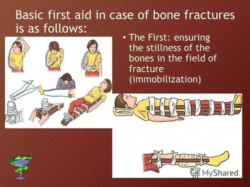 Basic first aid in case of bone fractures is as follows: The First: ensuring the stillness of the bones in the field of fracture (immobilization)
