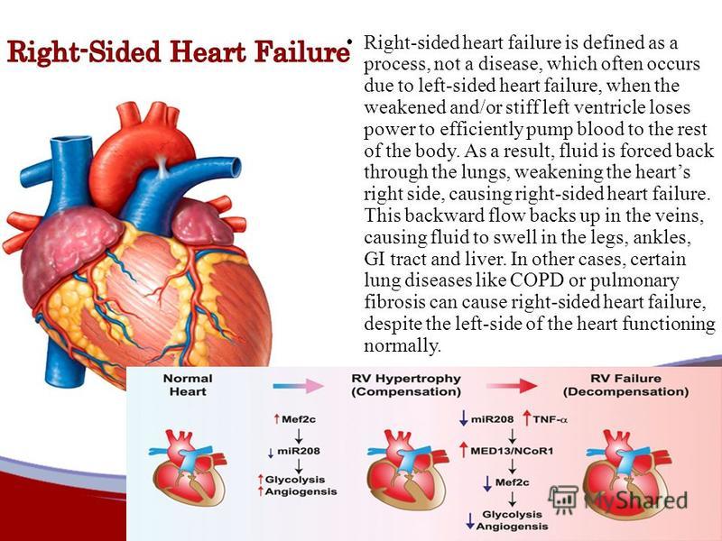 Right-sided heart failure is defined as a process, not a disease, which often occurs due to left-sided heart failure, when the weakened and/or stiff left ventricle loses power to efficiently pump blood to the rest of the body. As a result, fluid is f