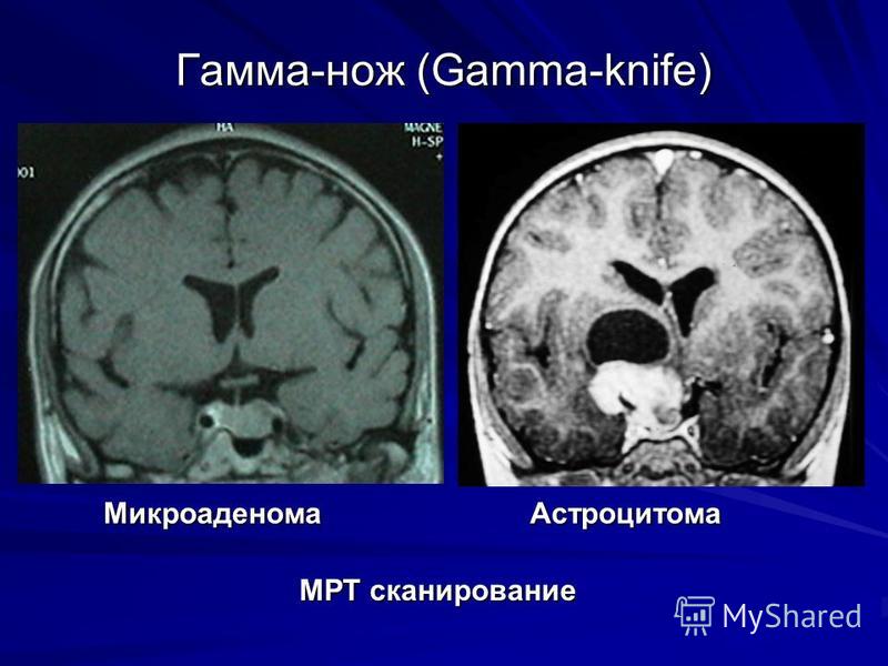 Гамма-нож (Gamma-knife) МРТ сканирование Микроаденома Астроцитома