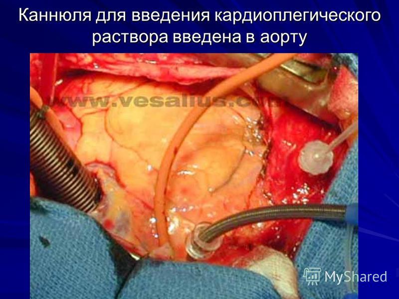 Каннюля для введения кардиоплегического раствора введена в аорту