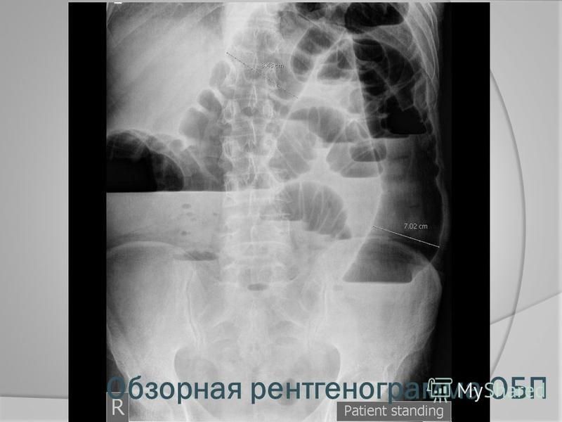 Обзорная рентгенограмма ОБП