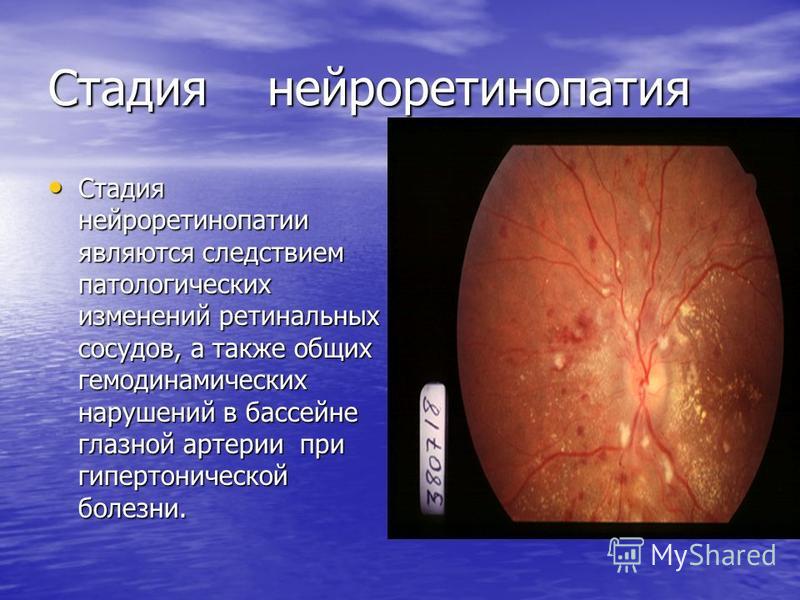 Стадия нейроретинопатия Стадия нейроретинопатии являются следствием патологических изменений ретинальных сосудов, а также общих гемодинамических нарушений в бассейне глазной артерии при гипертонической болезни. Стадия нейроретинопатии являются следст