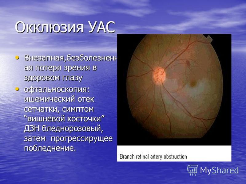 Окклюзия УАС Внезапная,безболезненная потеря зрения в здоровом глазу Внезапная,безболезненная потеря зрения в здоровом глазу офтальмоскопия: ишемический отек сетчатки, симптом вишневой косточки ДЗН бледно-розовый, затем прогрессирующее побледнение. о