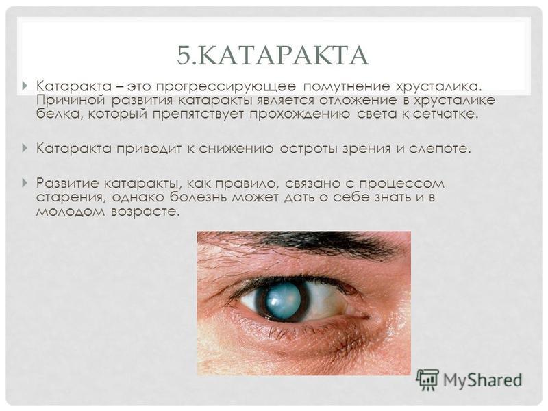 5. КАТАРАКТА Катаракта – это прогрессирующее помутнение хрусталика. Причиной развития катаракты является отложение в хрусталике белка, который препятствует прохождению света к сетчатке. Катаракта приводит к снижению остроты зрения и слепоте. Развитие