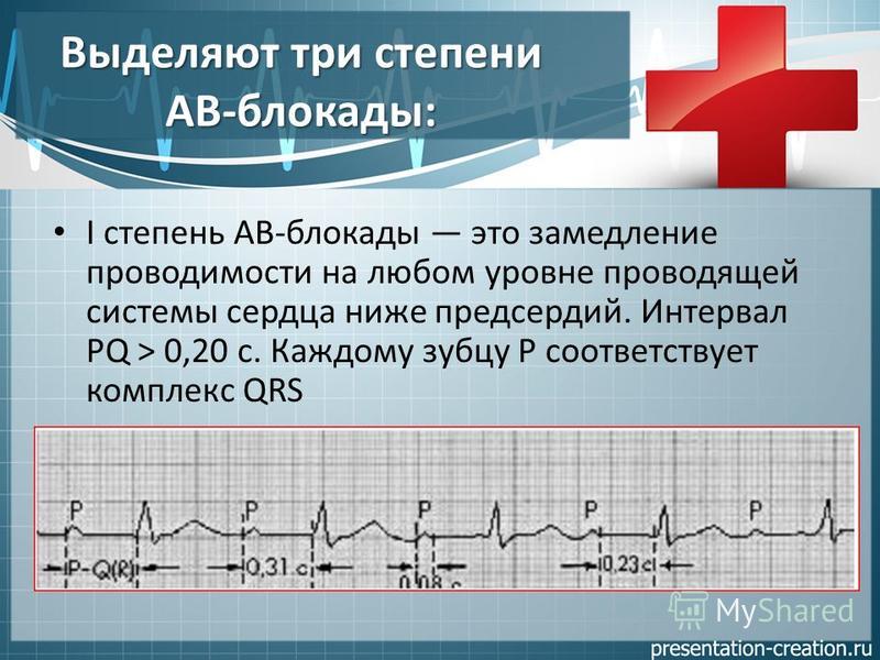 Выделяют три степени АВ-блокады: I степень АВ-блокады это замедление проводимости на любом уровне проводящей системы сердца ниже предсердий. Интервал PQ > 0,20 с. Каждому зубцу P соответствует комплекс QRS
