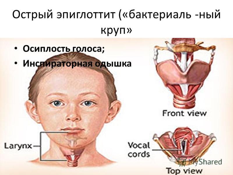 Острый эпиглоттит («бактериальный круп» Осиплость голоса; Инспираторная одышка