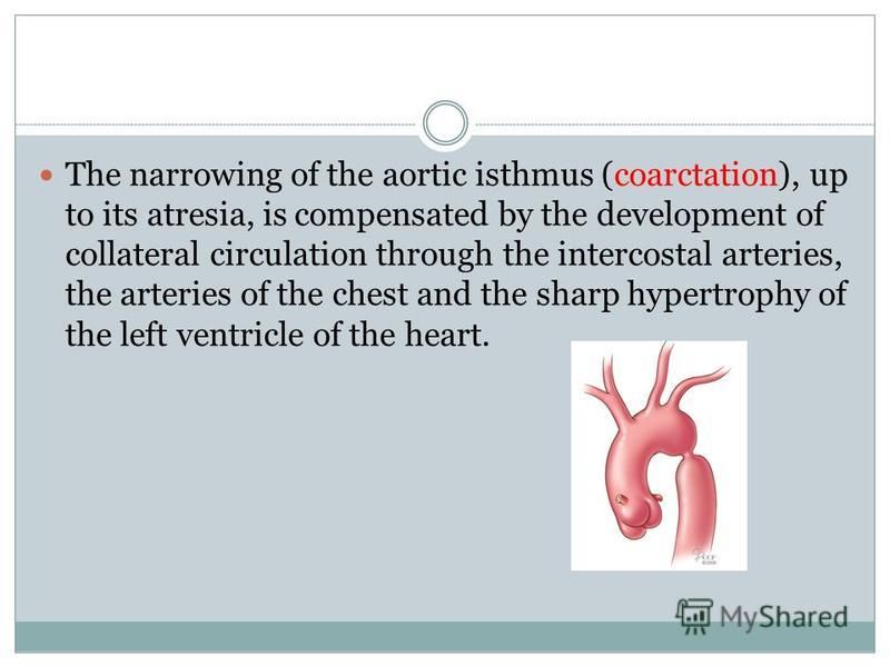 The narrowing of the aortic isthmus (coarctation), up to its atresia, is compensated by the development of collateral circulation through the intercostal arteries, the arteries of the chest and the sharp hypertrophy of the left ventricle of the heart