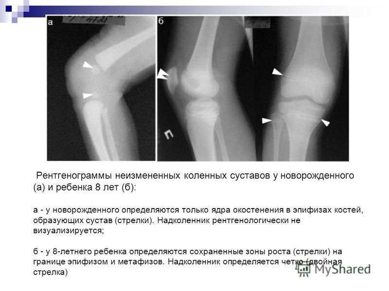 Рентгенограммы неизмененных коленных суставов у новорожденного (а) и ребенка 8 лет (б): а - у новорожденного определяются только ядра окостенения в эпифизах костей, образующих сустав (стрелки). Надколенник рентгенологически не визуализируется; б - у 