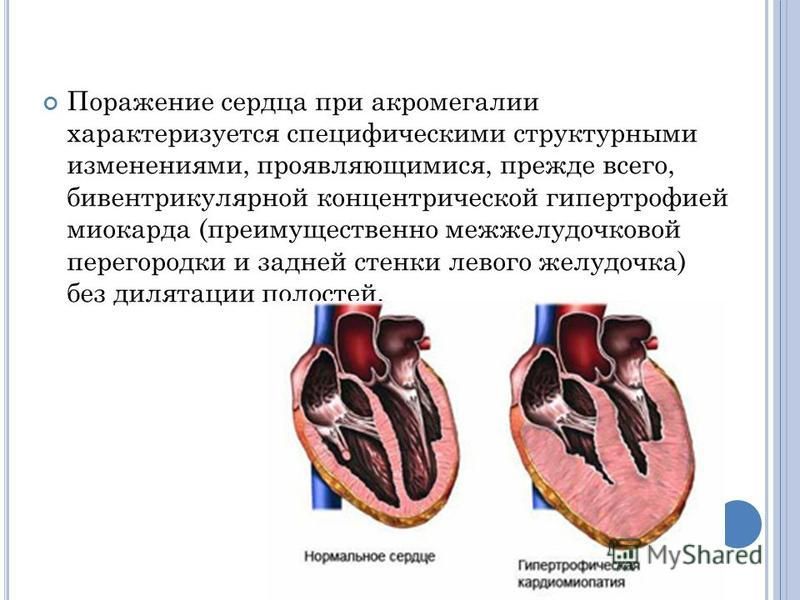 Гипертрофия мжп сердца что это 2