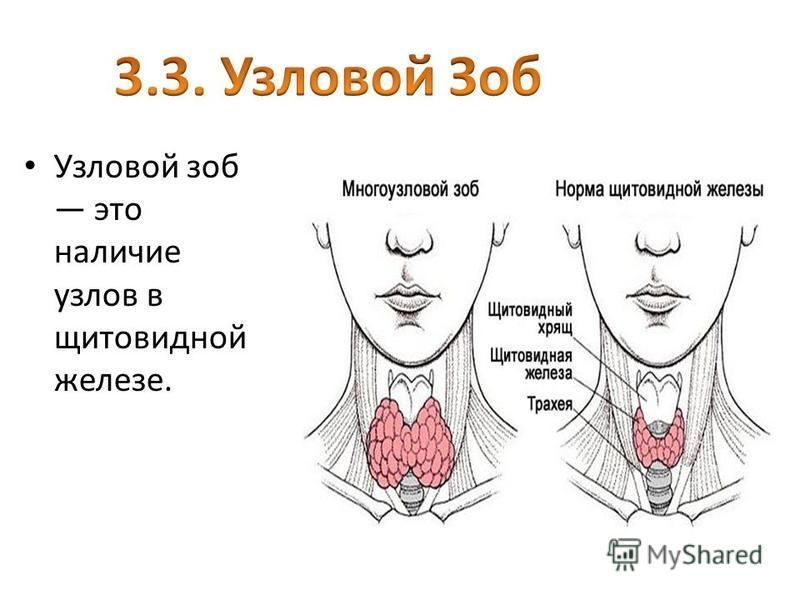 Узловой зоб это наличие узлов в щитовидной железе.
