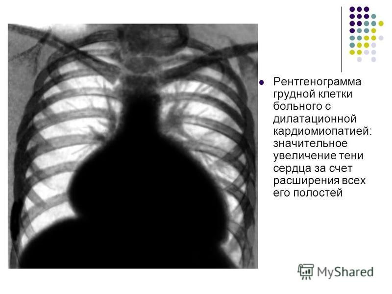 Рентгенограмма грудной клетки больного с дилатационной кардиомиопатией: значительное увеличение тени сердца за счет расширения всех его полостей