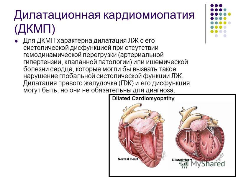 Дилатационная кардиомиопатия (ДКМП) Для ДКМП характерна дилатация ЛЖ с его систолической дисфункцией при отсутствии гемодинамической перегрузки (артериальной гипертензии, клапанной патологии) или ишемической болезни сердца, которые могли бы вызвать т