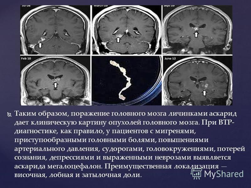 Таким образом, поражение головного мозга личинками аскарид дает клиническую картину опухолей головного мозга. При ВТР- диагностике, как правило, у пациентов с мигренями, приступообразными головными болями, повышениями артериального давления, судорога
