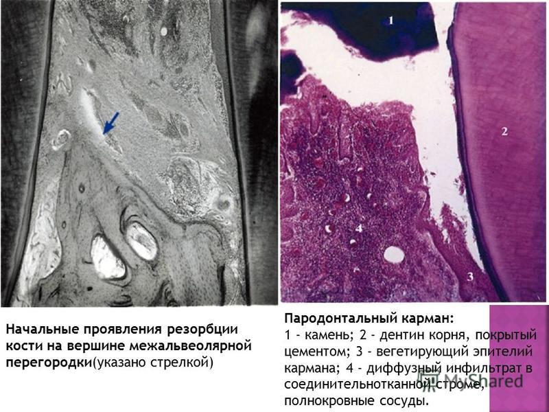 Начальные проявления резорбции кости на вершине межальвеолярной перегородки(указано стрелкой) Пародонтальный карман: 1 - камень; 2 - дентин корня, покрытый цементом; 3 - вегетирующий эпителий кармана; 4 - диффузный инфильтрат в соединительнотканной с