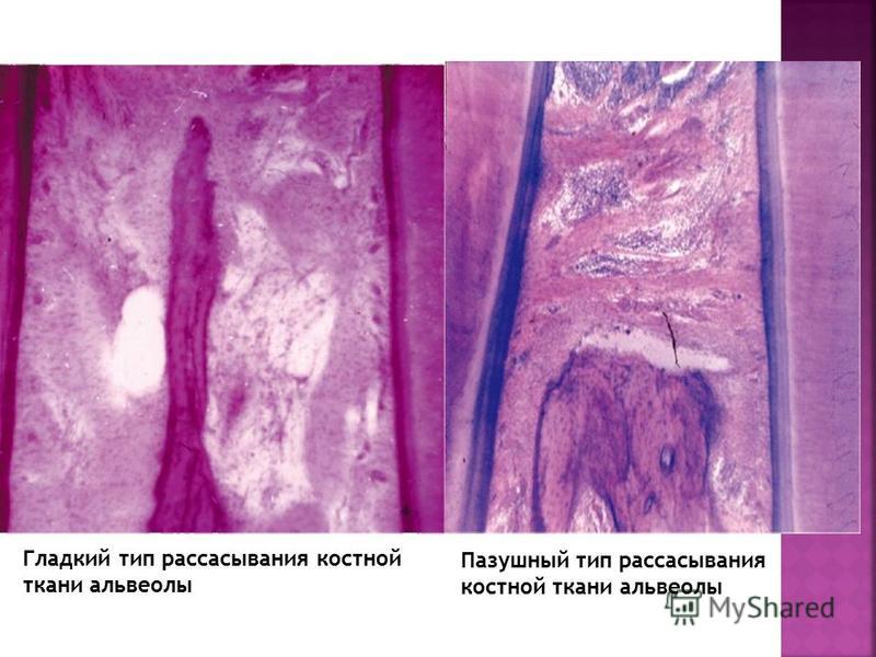 Гладкий тип рассасывания костной ткани альвеолы Пазушный тип рассасывания костной ткани альвеолы