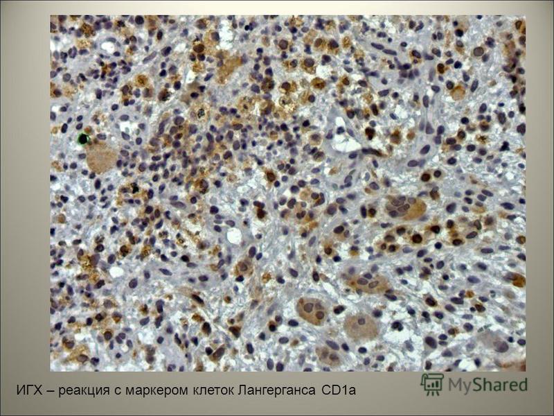 ИГХ – реакция с маркером клеток Лангерганса CD1a