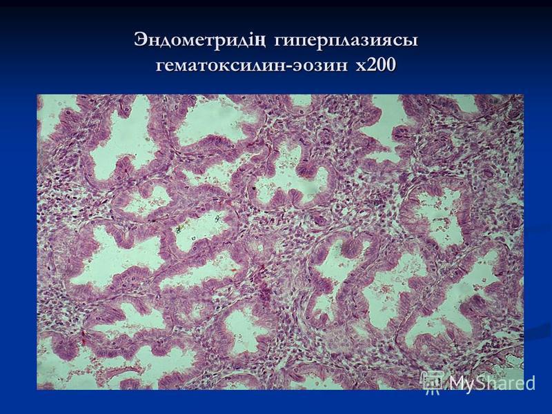 Эндометриді ң гиперплазиясы гематоксилин-эозин х 200