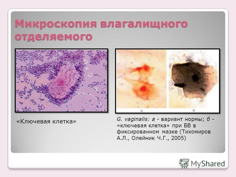 Микроскопия влагалищного отделяемого G. vaginalis: а - вариант нормы; б - «ключевая клетка» при БВ в фиксированном мазке (Тихомиров А.Л., Олейник Ч.Г., 2005) «Ключевая клетка»