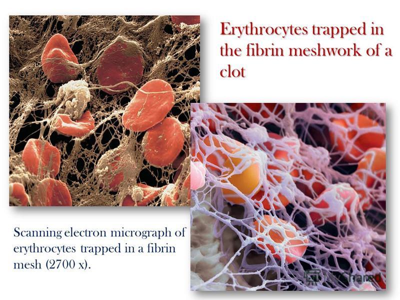 Scanning electron micrograph of erythrocytes trapped in a fibrin mesh (2700 x). Erythrocytes trapped in the fibrin meshwork of a clot