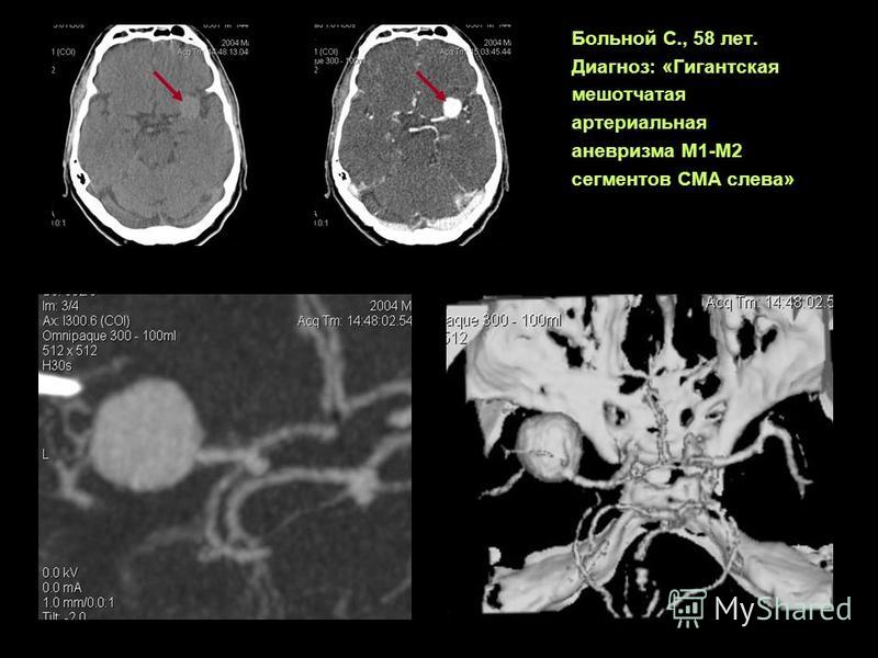 Больной С., 58 лет. Диагноз: «Гигантская мешотчатая артериальная аневризма М1-М2 сегментов СМА слева»