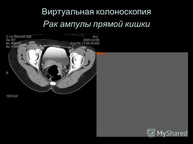 Виртуальная колоноскопия Рак ампулы прямой кишки