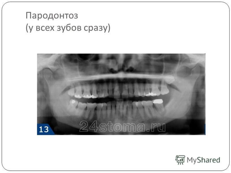 Пародонтоз ( у всех зубов сразу )
