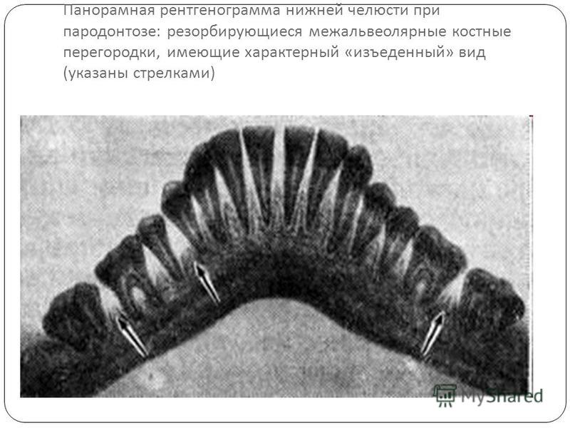 Панорамная рентгенограмма нижней челюсти при пародонтозе : ресорбирующиеся меж альвеолярные костные перегородки, имеющие характерный « изъеденный » вид ( указаны стрелками )
