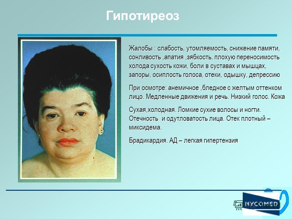 Остеохондроз ухудшение памяти Остеохондроз ухудшение памяти