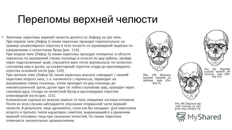 Перелом верхней челюсти презентация