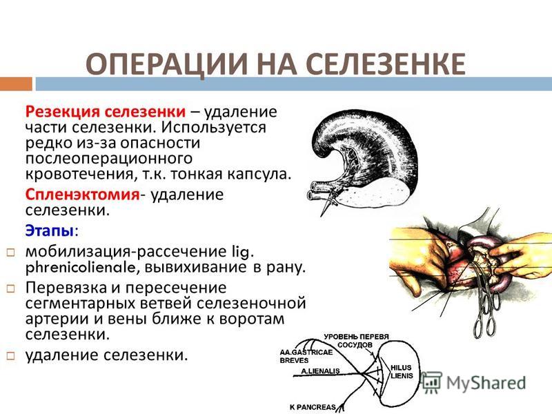 Как снять пленку с селезенки Презентация на тему: "ТОПОГРАФИЧЕСКАЯ АНАТОМИЯ И ОПЕРАЦИИ НА ПАРЕНХИМАТОЗНЫХ ОРГ
