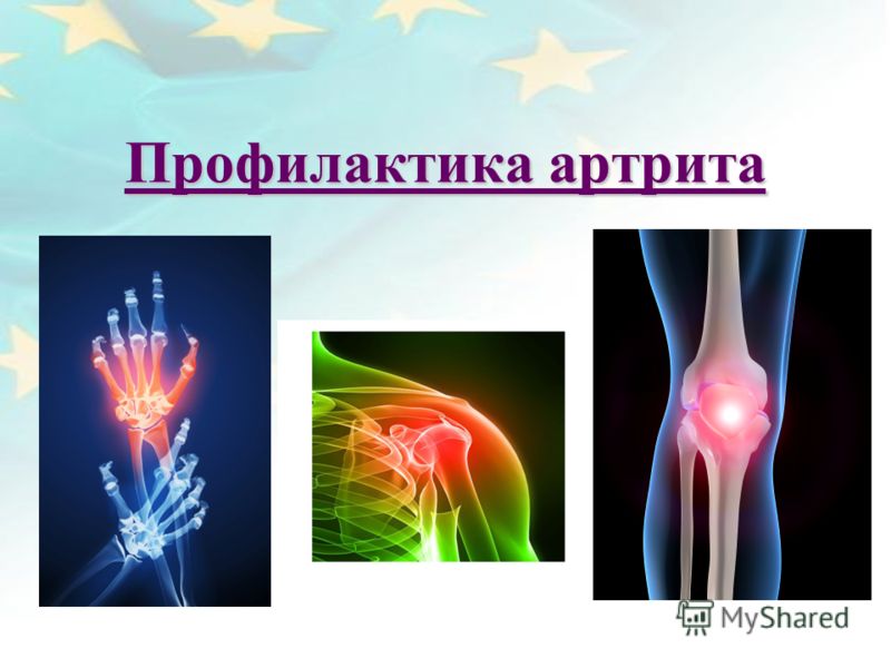 Презентация На Тему Артрит Презентация На Тему Артрит