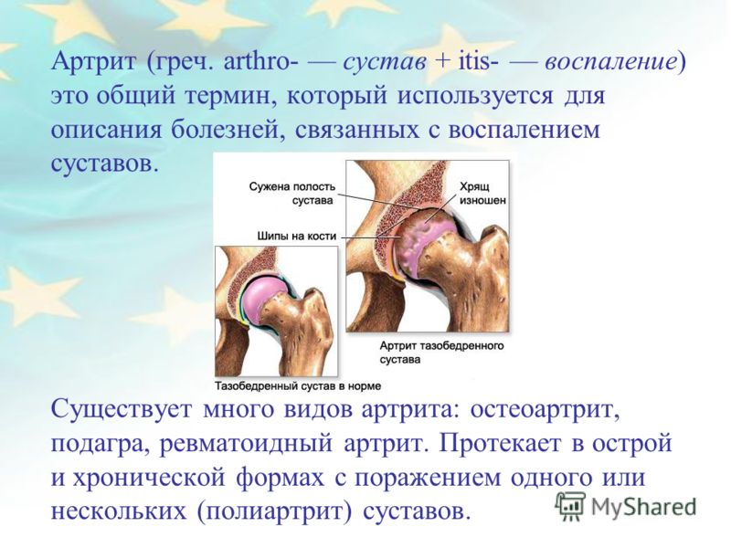 Презентация На Тему Ревматоидный Артрит Презентация На Тему Ревматоидный Артрит
